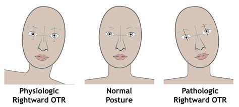 Cats with vestibular disease often tilt their head and fall to one side because they are feeling imbalanced or lack coordination due to the disease. Ocular Tilt Reaction