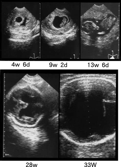 Intrauterine High Resolution Magnetic Resonance Imaging In Fetal
