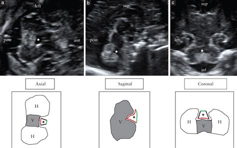 Prenatal Abnormal Features Of The Fourth Ventricle In Joubert Syndrome
