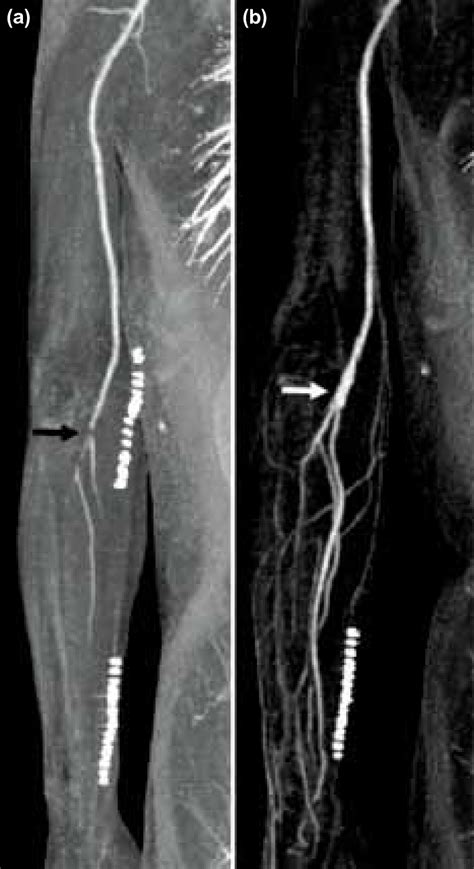 A Preoperative Ct Angiography Shows Brachial Artery Occlusion Black