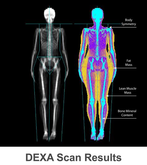 Dxa Scan Results