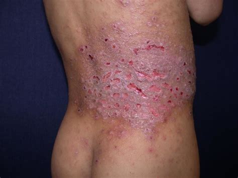 Punched Out Ulcers Of Eczema Herpeticum Confined To Plaques Of Eczema