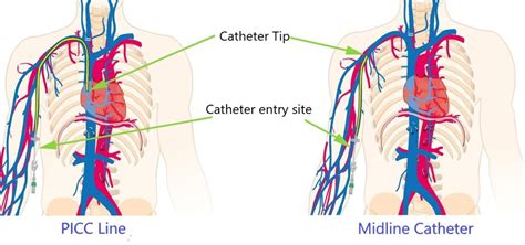 Picc Line And Midline Catheter La Vascular