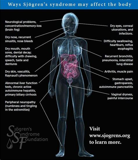 Sjogrens Syndrome Fibromyalgia And Other Autoimmune Diseases Pinterest