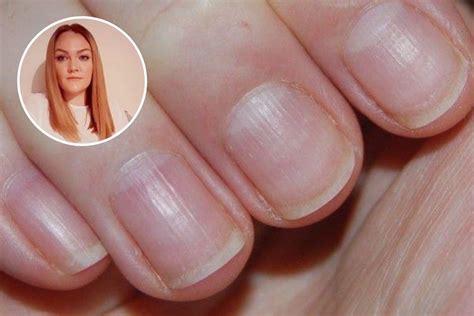 Ridged Nails Heres Why And How To Treat Them Scratch