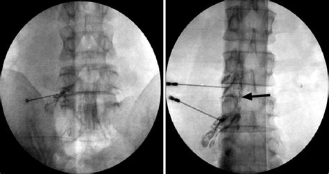 Interlaminar Epidural Steroid Injection