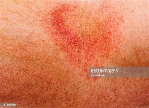 Red Rash Arm Photos And Premium High Res Pictures Getty Images