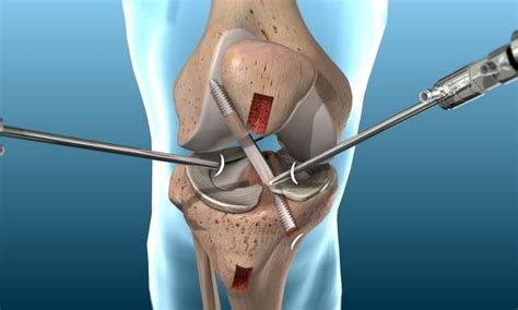 Acl Reconstruction Dr Patrick Chin Orthopedic Surgeon Vancouver