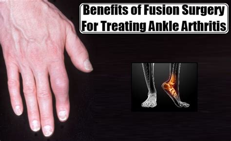 Risks And Benefits Of Fusion Surgery For Treating Ankle Arthritis