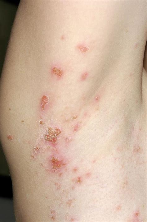 Impetigo Rash Photograph By Dr P Marazziscience Photo Library