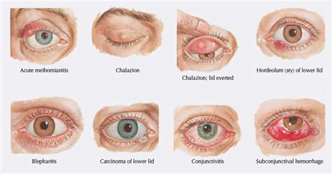 Allergic Bacterial And Viral Types Of Pink Eye Can All Result In