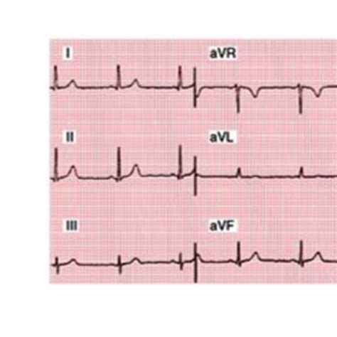 A Electrode Placement In 12 Lead System B 12 Lead Ecg C Einthovens