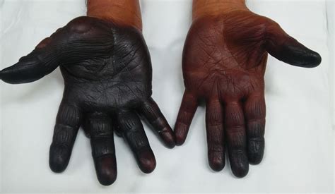 Discoloration And Bullous Lesions On The Hands Mdedge Dermatology