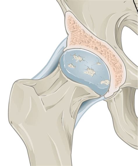 Osteoarthritis Of The Hip Joint Pain Info