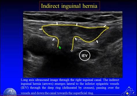 Ultrasound Imaging Of Hernia Parts Of A Youtube Video Tom Wade Md Ultrasound
