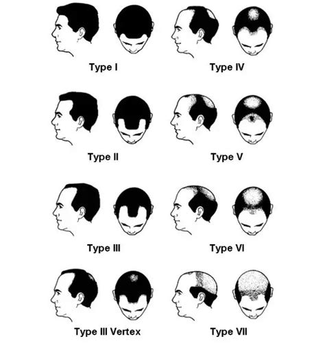 Norwood Hamilton Scale The Stages Of Male Pattern Baldness Stages Of