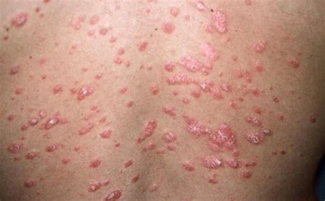 ¿cuáles Son Los Tipos De Psoriasis Mejor Con Salud