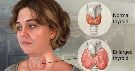 Diffuse Toxic Goiter My Science Laboratory