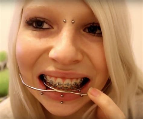 Braces Braceface Metalbraces Girlswithbraces Headgear Zahnspange