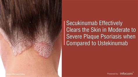 Secukinumab Is Effective In Moderate To Severe Plaque Psoriasis When