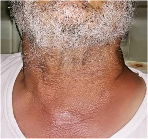 Picture Of The Patients Neck Showing Left Sided Swelling Without