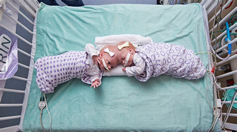 doctors just separated twin girls joined at the head in one of the world s rarest surgeries