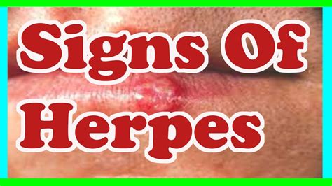 Beginning Herpes Symptoms Women Herpes Symptoms Diagnosis