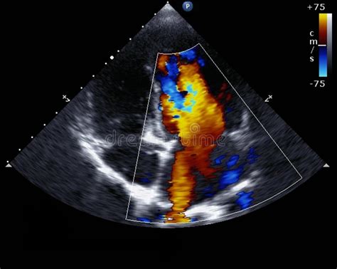 Doppler Echocardiography Stock Image Image Of Medicine 52734865