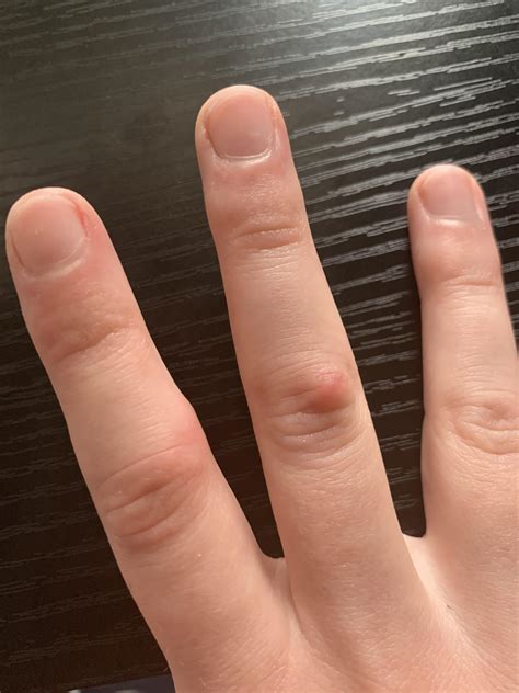 red swollen bumps on finger joints r diagnoseme