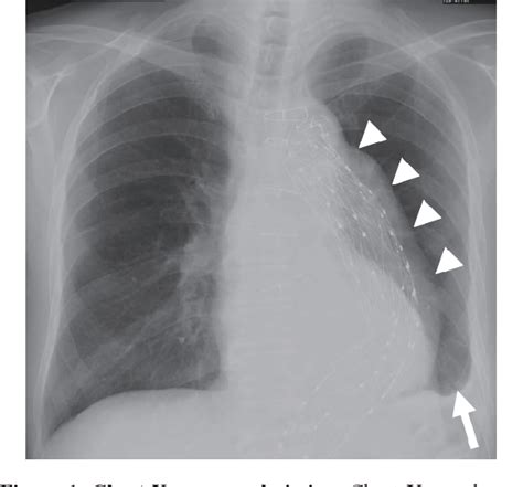 Figure 1 From Aortopulmonary Fistula Caused By An Infected Thoracic