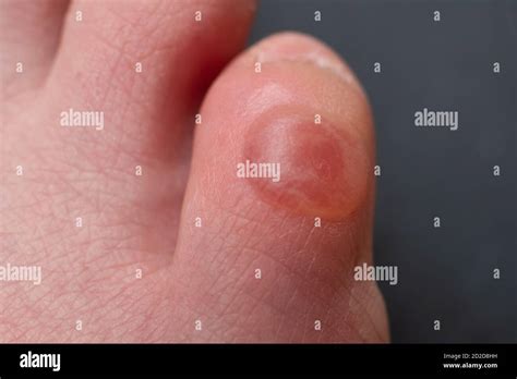 Callus On Pinky Toe After Wearing Uncomfortable Shoes Close Up View