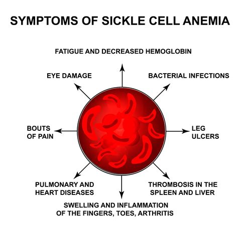 Anemia Falciforme O Que é Quais As Causas E Tratamento