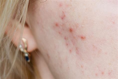 Cystic Acne Causes Symptoms And Medical Treatment