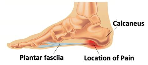 Plantar Fasciitis Our Complete Guide Cornerstone Physiotherapy