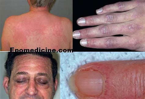 Skin Signs Of Dermatomyositis Heliotrope Rash Grotton Papules And