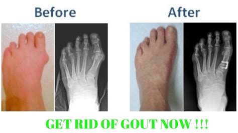 How To Get Rid Of Gout In 24 Hours Youtube