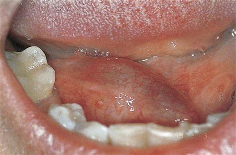 Salivary Obstruction Clinical Features Incidence Etiology Diagnosis
