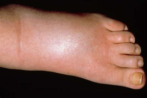 Foot Pain Nhsuk