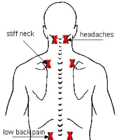 Neck And Shoulder Pain Acupressure Points Mapasebab