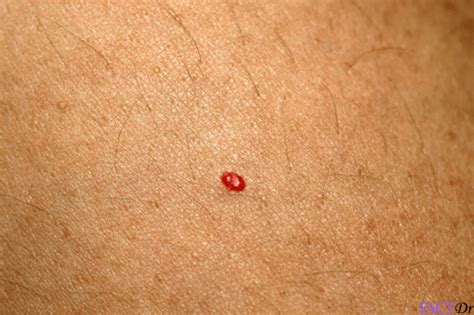 Cherry angiomas are sometimes referred to as senile angiomas, or campbell de morgan spots, and they are very much related to aging. Cherry Angioma : Symptoms, causes, severity, & treatment ...