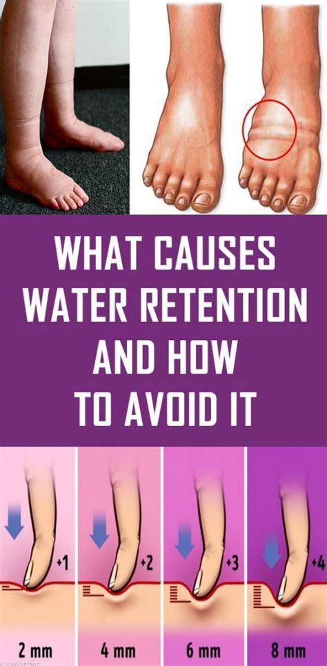 What Causes Water Retention And How To Avoid It Water Retention Water Retention Remedies