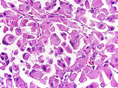 Pathology Outlines Rhabdoid Variant Of Clear Cell Renal Cell Carcinoma