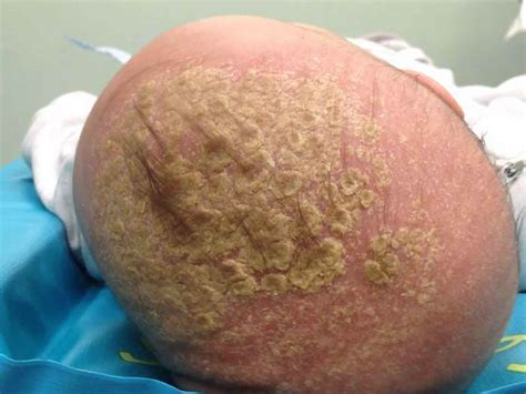 Infantile Seborrheic Dermatitis Causes Symptoms Diagnosis And Treatment