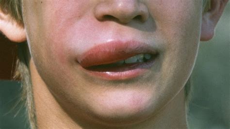 Can Bug Bites Cause Swollen Lips