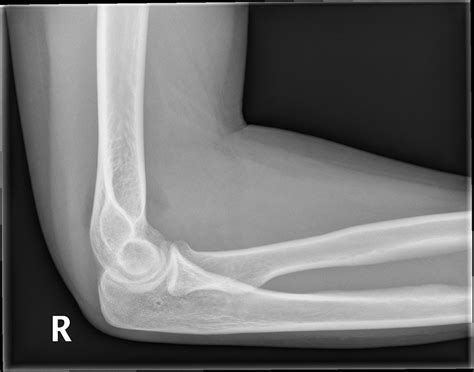 Elbow Joint Effusion Buyxraysonline