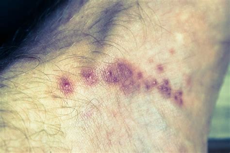 Skin Problems In Ckd How Kidney Disease Affects The Skin