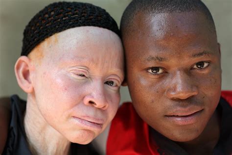 Being Black In A White Skin Students With Albinism Battle Prejudice
