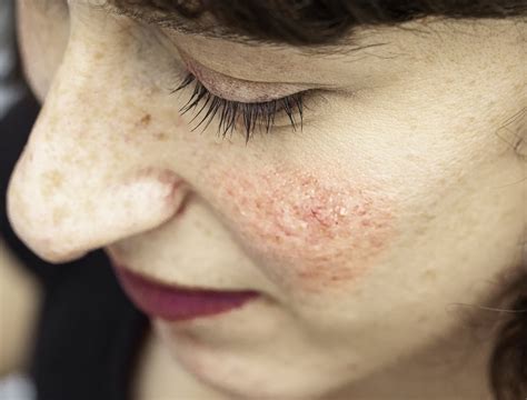 Santé Dermatologie La Rosacée Une Maladie De Peau Peu Connue