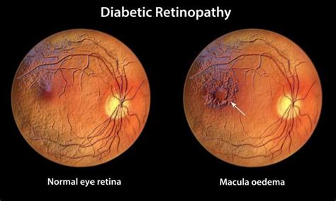 Oral Therapy For Diabetic Macular Oedema Progresses To Phase Ii Drug