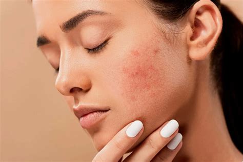 What Is Hormonal Acne And Expert Hormonal Acne Treatment Options